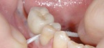 Dental flossing